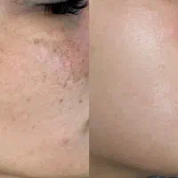 برداشت تخصصی کک ومک ژل بوتاکس جوانسازی