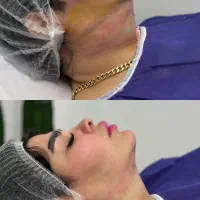 لیپوساکسشن غبغب