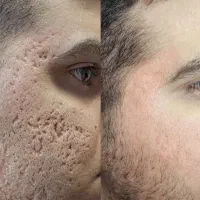 رفع اسکار فقط یکدوره بدون روش تهاجمی