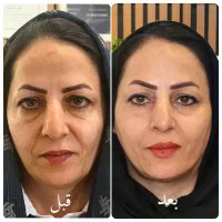 لیفت صورت با نخ با تکنیک لومِن ،بدون جراحی و درد
