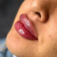 تزریق فیلر لب و بوتاکس در کلینیک  باراک