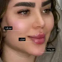 تزریق فیلربادی باسن هیپ دیپ ژل صورت،تجربه متفاوت