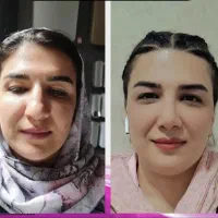 جراحی بینی