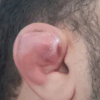 شکستن گوش با دو انگشت