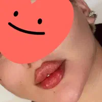 تزریق ژل و بوتاکس