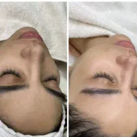 خدمات vip پوست ( پاکسازی و فشیال تخصصی )