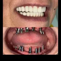 دندان مصنوعی بر پایه ایمپلنت(زهره)