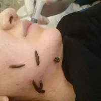 حجامت. فصد. زالودرمانی. بادکش گرم.