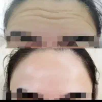 آفر بوتاکس صورت