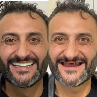 ایمپلنت کره ای۹۹۰۰  با ضمانت و اقساط ۶ ماهه