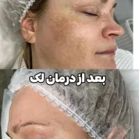 کربن تراپی صورت با دستگاه لیزر ناب وی(دکتر قاسمی)