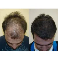 معجزه موهای پرپشت