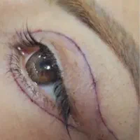 (بلفاروپلاستی ۷/۵میلیون مزوژل پرفایلو،دیمونو
