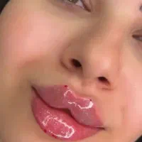تزریق ژل وبوتاکس ومزوتراپی