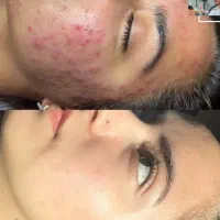 پاکسازی و فیشال پوست دست و صورت و اسکالپ کف سر