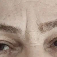 میکروبلیدینگ و فیبروز تخصصی