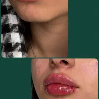 فیلر و ژل لب ، صورت و بدن ، دکتر اسدی صفا