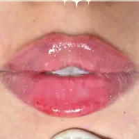 لیزر و بوتاکس وفیلر