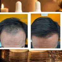 موهای جدید هدیه بگیر بدون کاشت