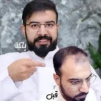 تخفیف ویژه کاشت مو فقط با   15 تومن