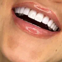 آفر ویژه کامپوزیت دندان فقط 2میلیون تومان