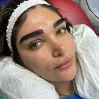 کاشت مو و ابرو تضمینی (مزو و پی آر پی)