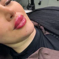 آف ژل بوتاکس مزو