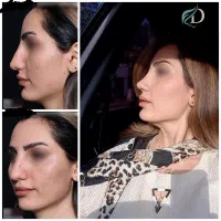 شرایط ویژه جراحی زیبایی بینی بهاره
