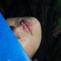 تزریق ژل و بوتاکس