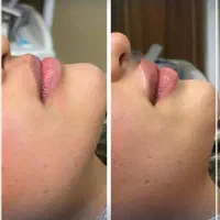 تزریق فیلر و بوتاکس ساکشن غبغب و بوکال فت
