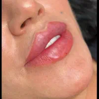 تخفیف تزریق و آموزش ژل بوتاکس و مزوتزاپی و آنزیم