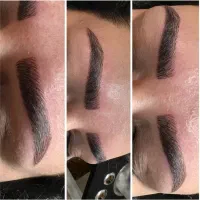 برداشتن خال و  میکروبلیدینگ ومیکاپ دائم