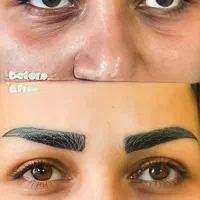 فیلرمادلینگ۲۵۹۰تزریق ژل زاویه prpمزوعیدانه