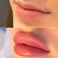 جشنواره آفر مدل ژل بوتاکس مزو مو جوانساز فیلر صورت