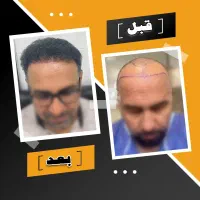 جشنواره بهاری کاشت تخصصی مو و ابرو + شرایط اقساط