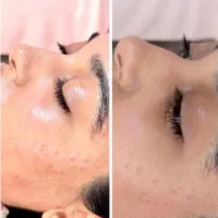 خدمات فیشال و پاکسازی پوست