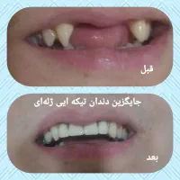 مرکز ساخت دندان های مصنوعی ژله‌ای