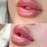فیلر و بوتاکس کانتورینگ  فیلر لب فیلر بینی لاغری