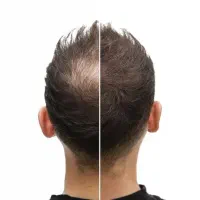 اگه خانومی یا مو کاشتی حتماً ببین