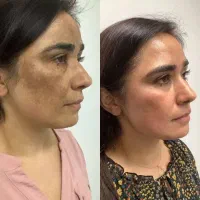 از بین بردن لک و چین و چروک