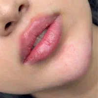 ژل بوتاکس مزو فیشیال حجامت خالبرداری پیرسینگ