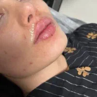 ژل بوتاکس با بهترین متریال فقط ۸۹۹تومان تضمینی