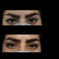 جراحی زیبایی پلک