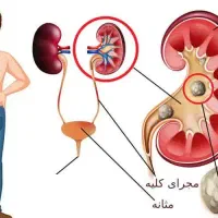 سنگ کلیه و مثانه