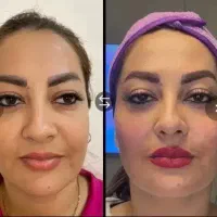فیلربوتاکس لیزر فیشیال پاکسازی