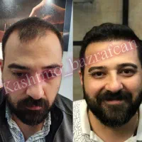 کاشت مو تکنسین شیرازی در تبریز
