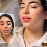 ژل بوتاکس لیزر