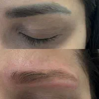 لیرز حذف تتو لک و خال