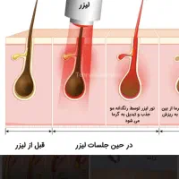 استخدام خانم اپراتور لیزر موی زائد