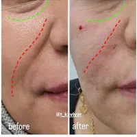 فیلر/ژل/بوتاکس/مزوتراپی/پی آر پی